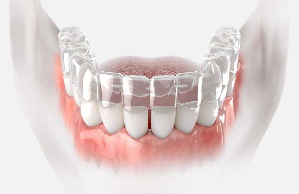 פתרון לשיניים עקומות